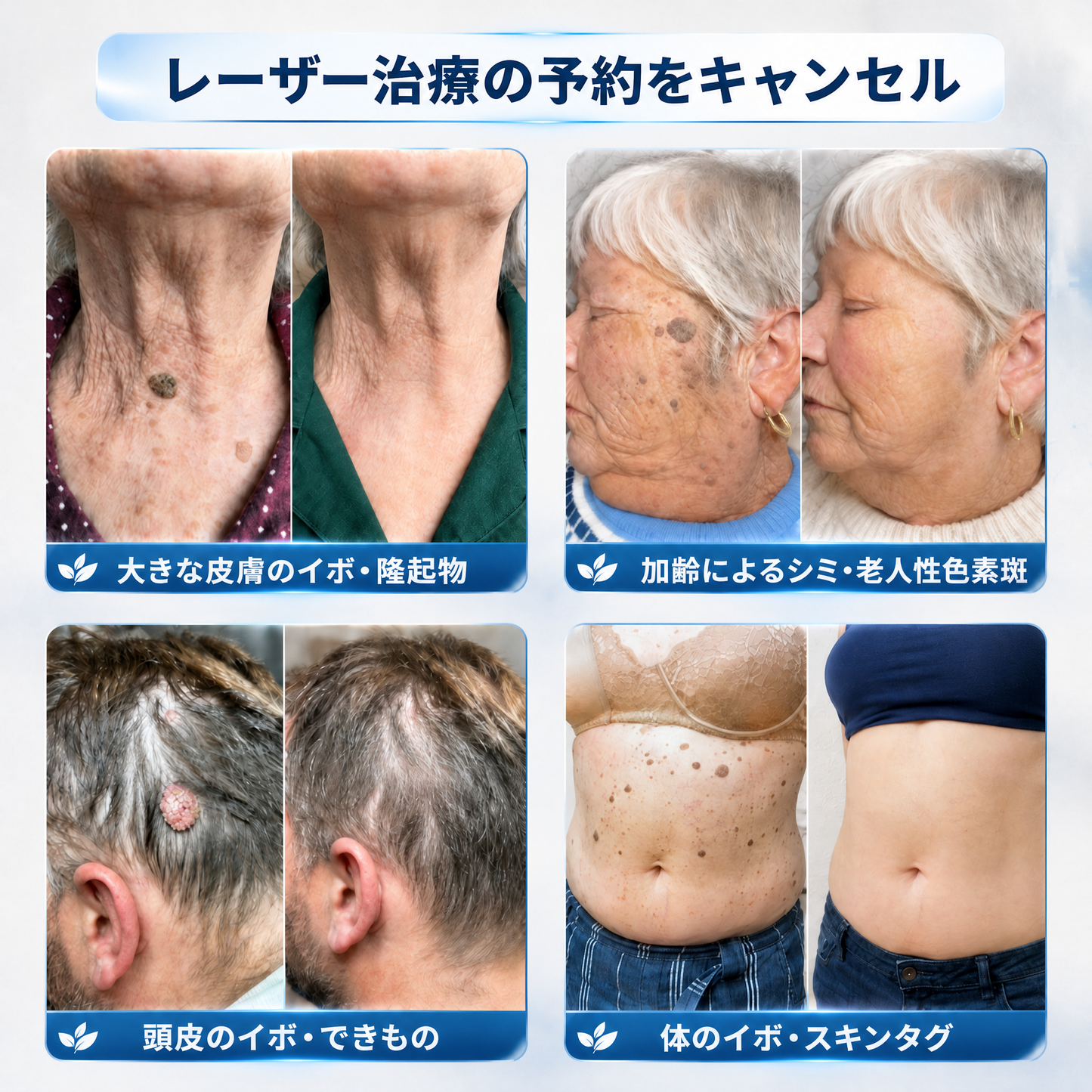 薬剤師もおすすめ🏆 GFOUK® 7日間 タグ＆スポットイレーサー🪄 （痛みゼロ・傷あとゼロを目指すローラーボールタイプ）👩‍⚕️