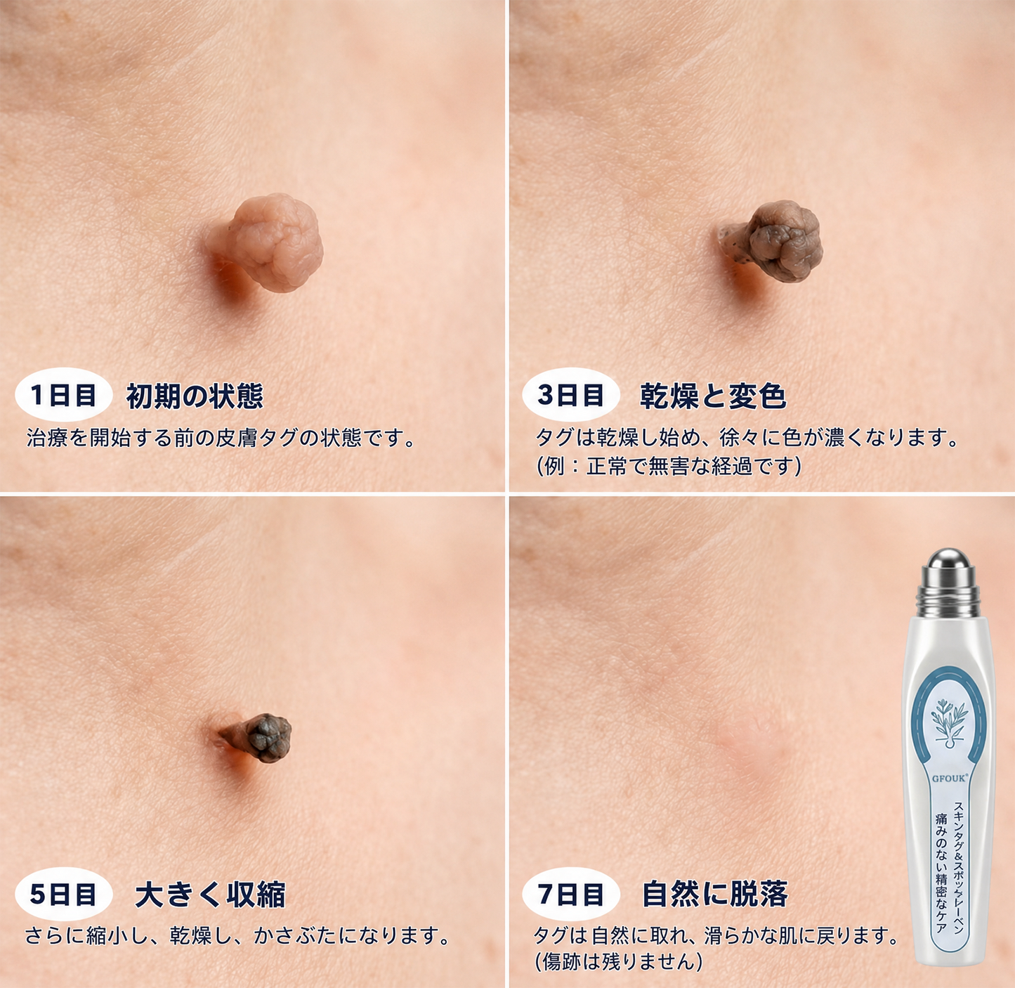 薬剤師もおすすめ🏆 GFOUK® 7日間 タグ＆スポットイレーサー🪄 （痛みゼロ・傷あとゼロを目指すローラーボールタイプ）👩‍⚕️