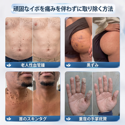 薬剤師もおすすめ🏆 GFOUK® 7日間 タグ＆スポットイレーサー🪄 （痛みゼロ・傷あとゼロを目指すローラーボールタイプ）👩‍⚕️
