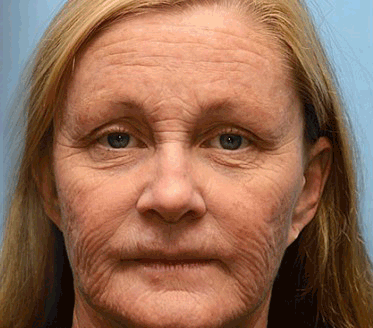 💎🍀Valmistettu ja lähetetty Suomesta ✅Furzero™ Botox-mehiläismyrkky ryppyjä poistava voide